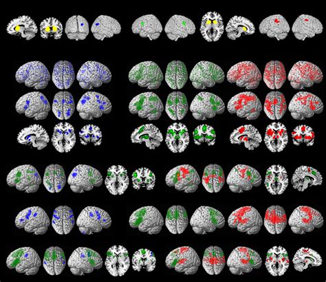 Functional Connectivity Modeling Of Consistent Cortico Striatal Atrophy