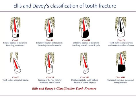 Classification Of Dental Fractures at Melissa Richter blog