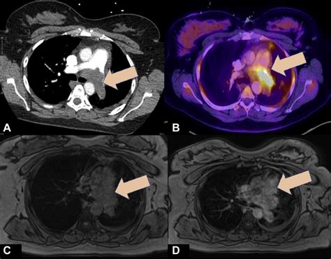 A 37-Year-Old Woman With Spindle Cell Sarcoma of the Pulmonary Arteries | Download Scientific ...