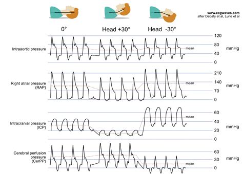 Sudden Cardiac Arrest and Cardiopulmonary Resuscitation (CPR) – The ...