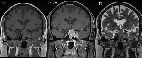 Prolaktinom Ars Neurochirurgica