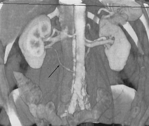 Three Dimensional Volume Rendered Ct Angiography Of The Renal Arteries And Veins Normal Anatomy