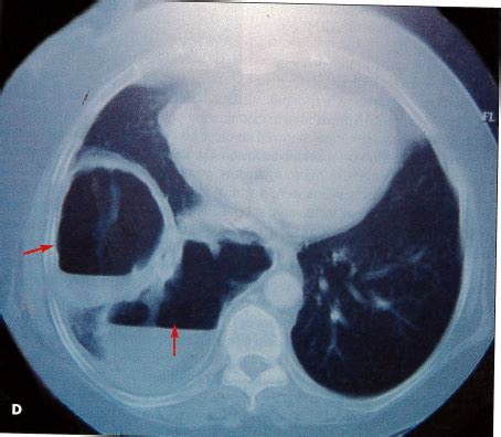 Cavitary Lung Cancer With Metastases | Consultant360