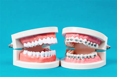 The History Of Braces Andros Orthodontics Tri Cities Orthodontics