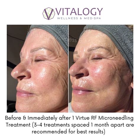 Virtue RF Microneedling Before After Vitalogy Wellness Med Spa