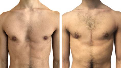 Clinical Case Nuss Redo For Pectus Excavatum By Dr Flavio Facchini