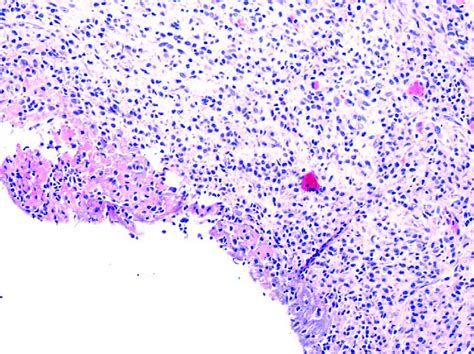 Photomicrograph Showing Chronic Mixed Inflammatory Cell Infiltrate