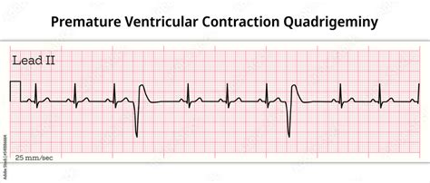 Photo Art Print ECG Premature Ventricular Contraction Trigeminy 8