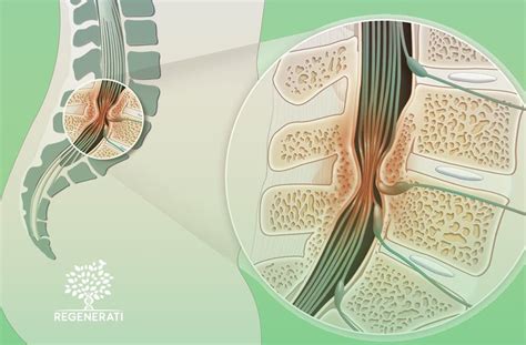 Arquivos Artrodese Cl Nica Regenerati Neurologia