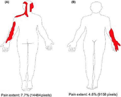 Determining The Level Of Cervical Radiculopathy Agreement Between