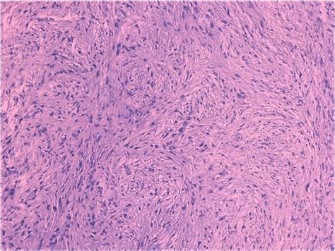 Tumoral Proliferation Of Spindel Cells Essentially Arranged In A