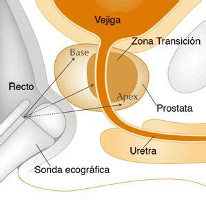 La Biopsia De Pr Stata Centro Gil Vernet De Urolog A