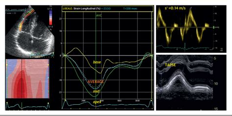 Figure 2 From Diagnostic Differentiation Between Arrhythmogenic