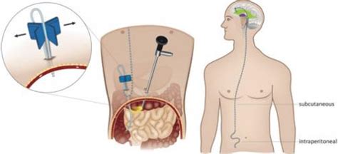 Using laparoscopy for ventriculoperitoneal shunt placement