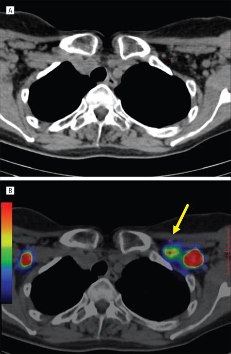 Recurrent Lymphangiectasia of the Left Supraclavicular Fossa: An ...