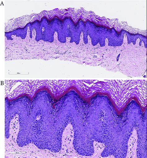 Dermatopathology Images Showing A Focal Compact Orthokeratosis