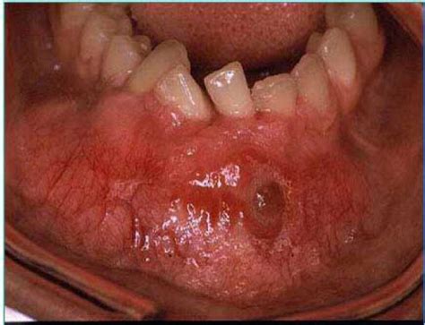 Figure 1 From Adenomatoid Odontogenic Tumor In Mandible Semantic Scholar