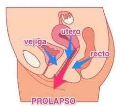 Prolapso De Vejiga S Ntomas Causas Y Tratamiento