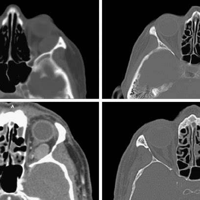 Access To The Lateral Orbit With Endoscopic Lateral Orbitotomy