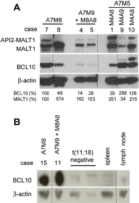 Expression Of MALT1 API2 Does Not Affect The BCL10 Protein Level In