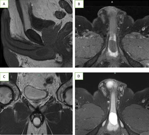 Corpus Spongiosum Cyst Bmj Case Reports