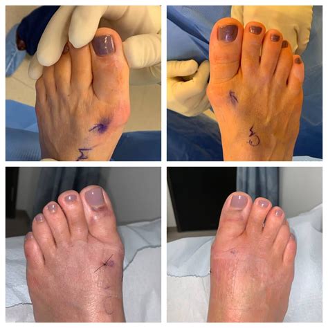 Hallux Rigidus – Arthritis of the big toe - Christopher Miller