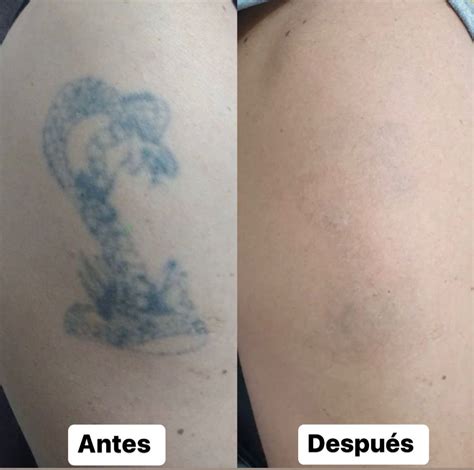 Remoción de tatuajes micropigmentación con láser LA CROIX URUGUAY