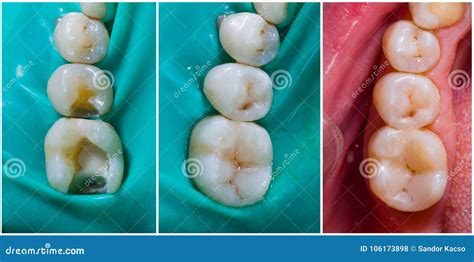 Upper Molar and Premolar Aesthetic Filling Stock Photo - Image of ...