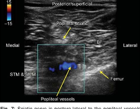 Popliteal Nerve Block Ultrasound