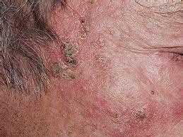 LA QUERATOSIS ACTÍNICA Shieko