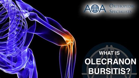 Aoa Orthopedic Specialists Olecranon Bursitis Youtube