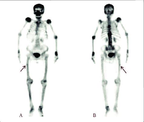 Whole Body Bone Scan Julie Parker