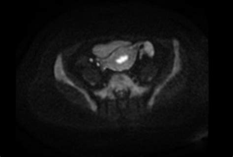 The Axial Section Of Dwi Mri Pelvis Sequence With Variation A B Value Download Scientific