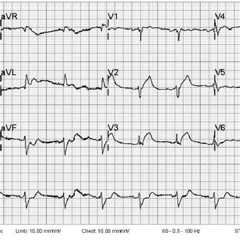 Initial ECG Showed To Low Voltage In Precordial Leads Subtle Elevation