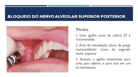 Revisão 2º bimestre Anestesia Local Odontológica Quizizz