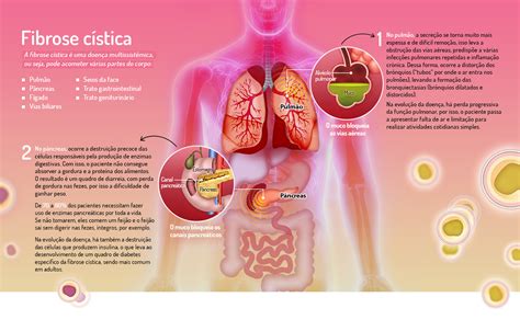 Fibrose Cística Entenda A Doença E Veja Relatos De Pacientes Que