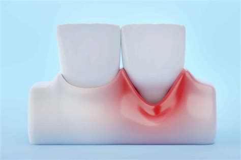 Déchaussement des dents Causes et traitements disponibles