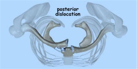 Sternoclavicular Joint Boston Shoulder Institute