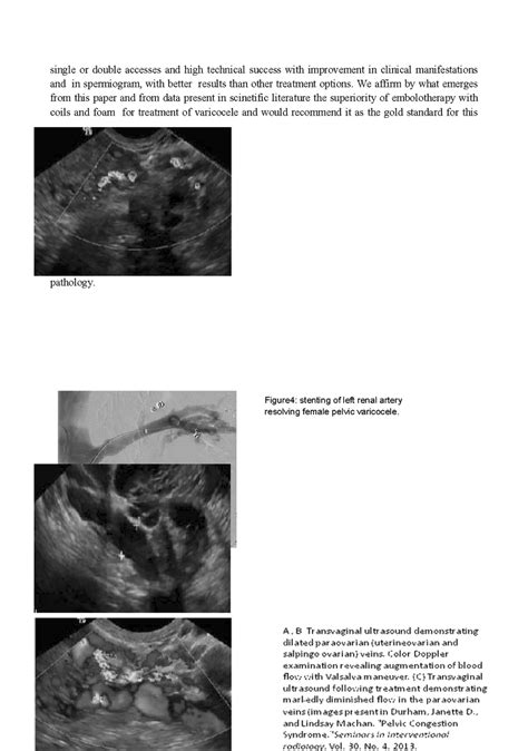 A B Transvaginal Ultrasound Demonstrating Dilated Paraovarian