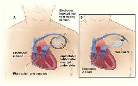 Control De Desfibrilador Autom Tico Implantado Dai Patient