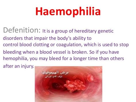 Haemophilia