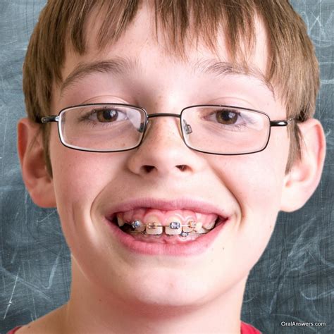 Braces Oral Answers