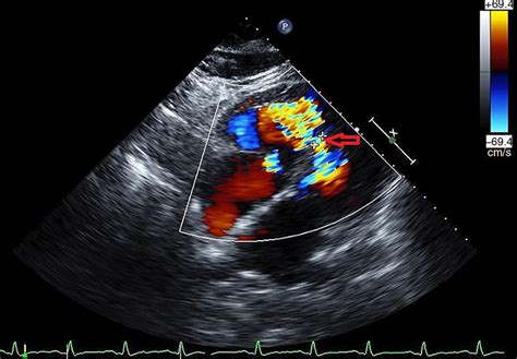 Echocardiogram With Color Doppler Displaying A Ventricular Septal