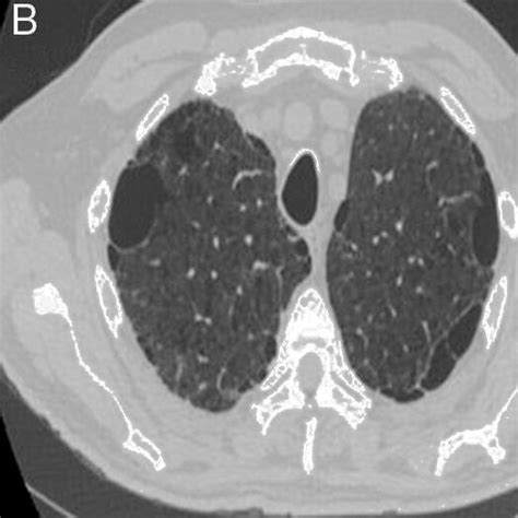 Patient with CPFE and LC. (A) Chest radiograph (posteroanterior ...