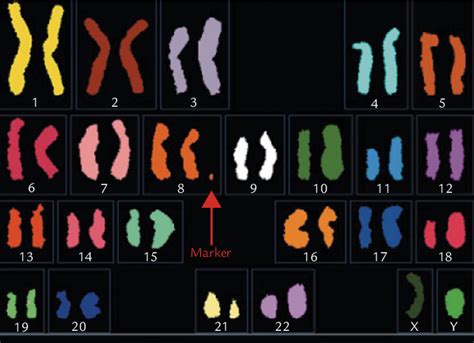 Figure From Prenatal Diagnosis And Molecular Cytogenetic