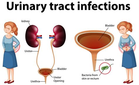 Fakta Medis Uretritis Infeksi Peradangan Di Uretra