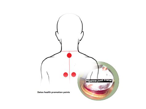 5 Important Reasons To Try Cupping Therapy Hijama Cupping Therapy