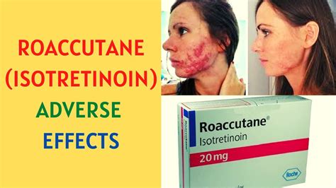 Isotretinoin Accutane Roaccutane Claravis Side Effects Youtube