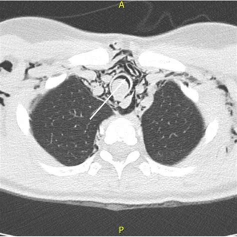 Chest Computed Tomography Ct Scan White Arrow Shows Near Total Download Scientific Diagram