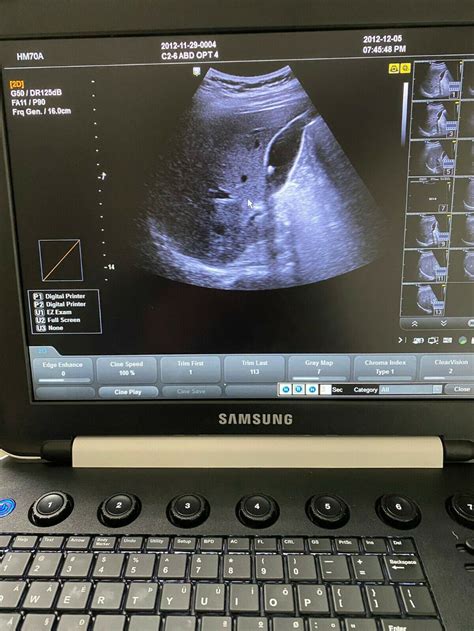 Samsung Hm70 Portable Hm70a With Plus Portable Ultrasound Machine 3